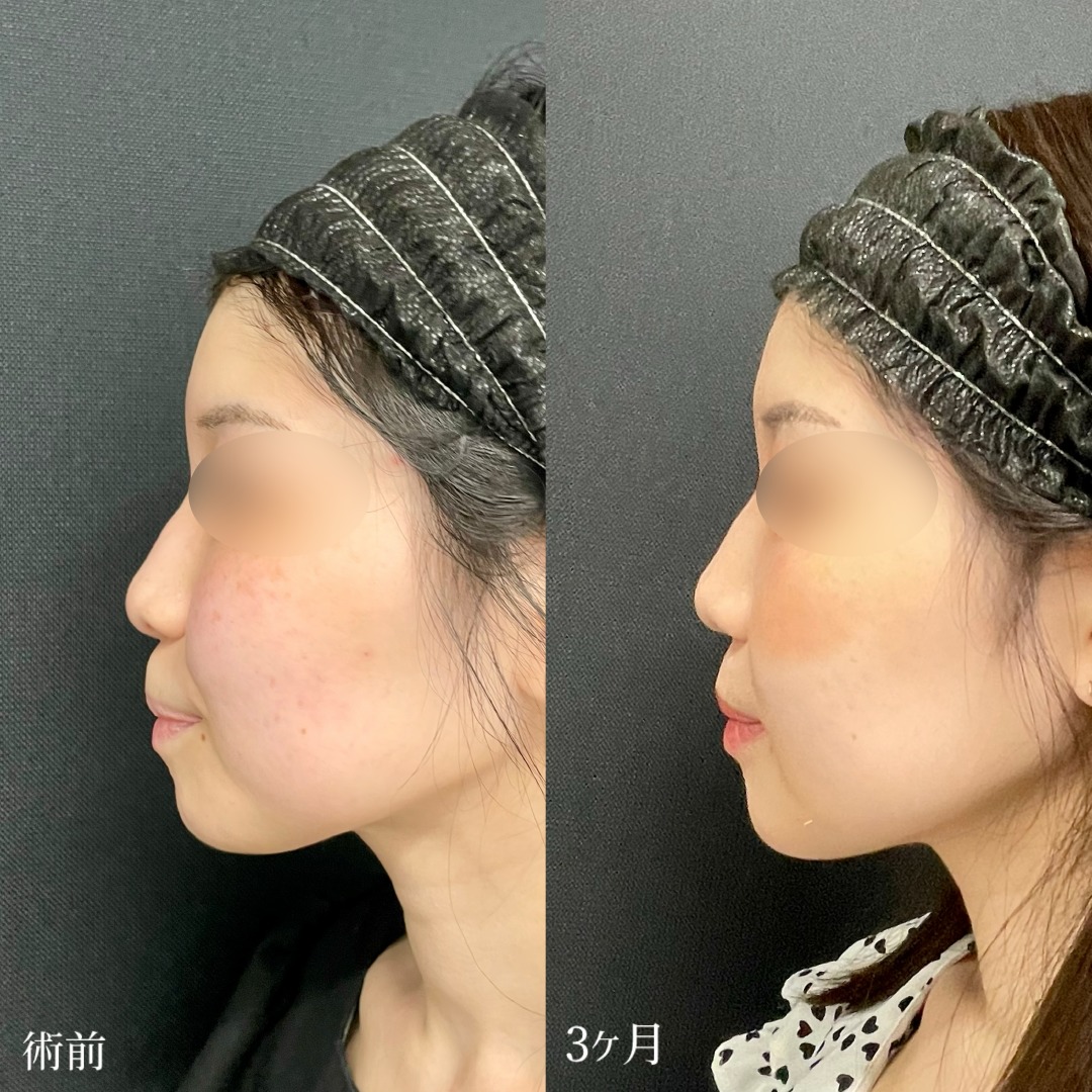 大宮の20代女性の小顔脂肪吸引の症例