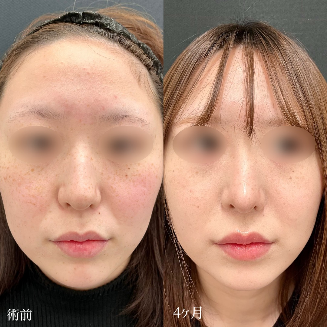 大宮の20代女性の鼻尖形成の症例