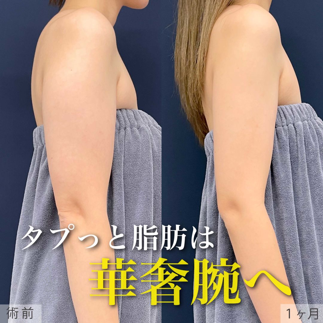 アキーセル脂肪吸引で二の腕痩せした30代女性の１ヶ月目症例