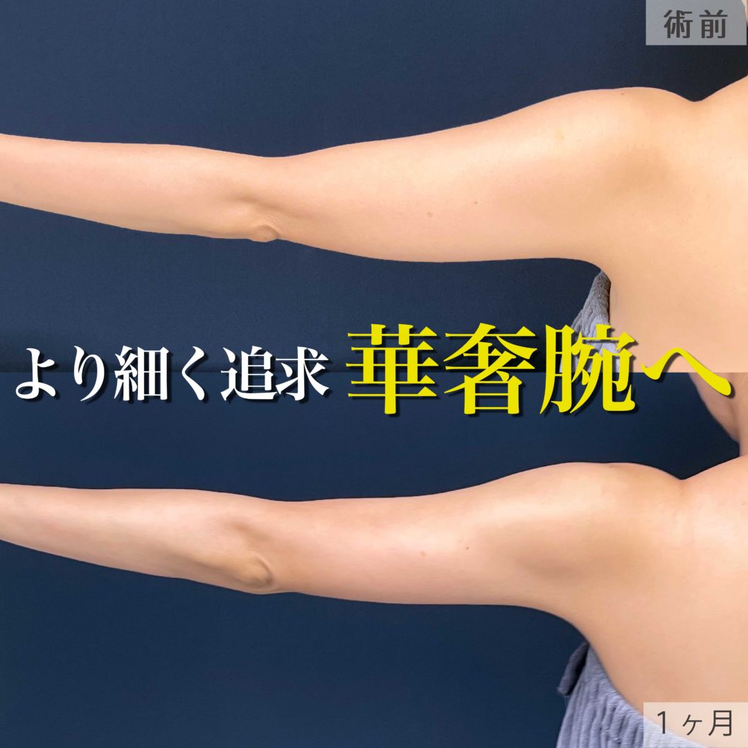 二の腕と肩の脂肪吸引をした40代女性の１ヶ月目症例