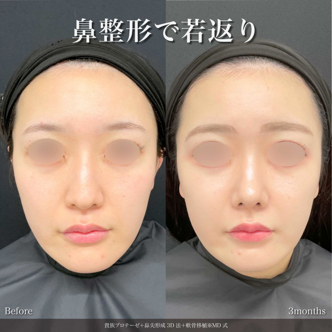 貴族プロテーゼと鼻尖形成3D法と軟骨移植をMD式で受けた女性の症例写真