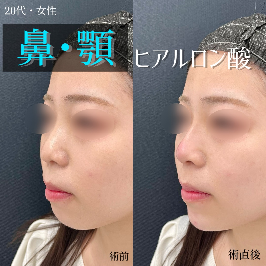 大宮の20代女性の鼻ヒアルロン酸の症例