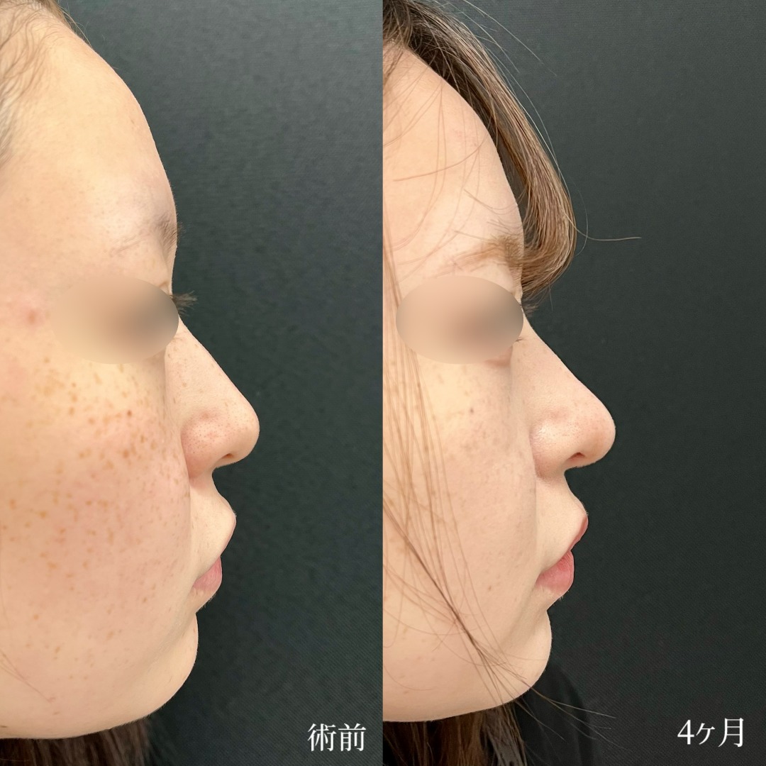 大宮の20代女性の鼻尖形成と軟骨移植の症例