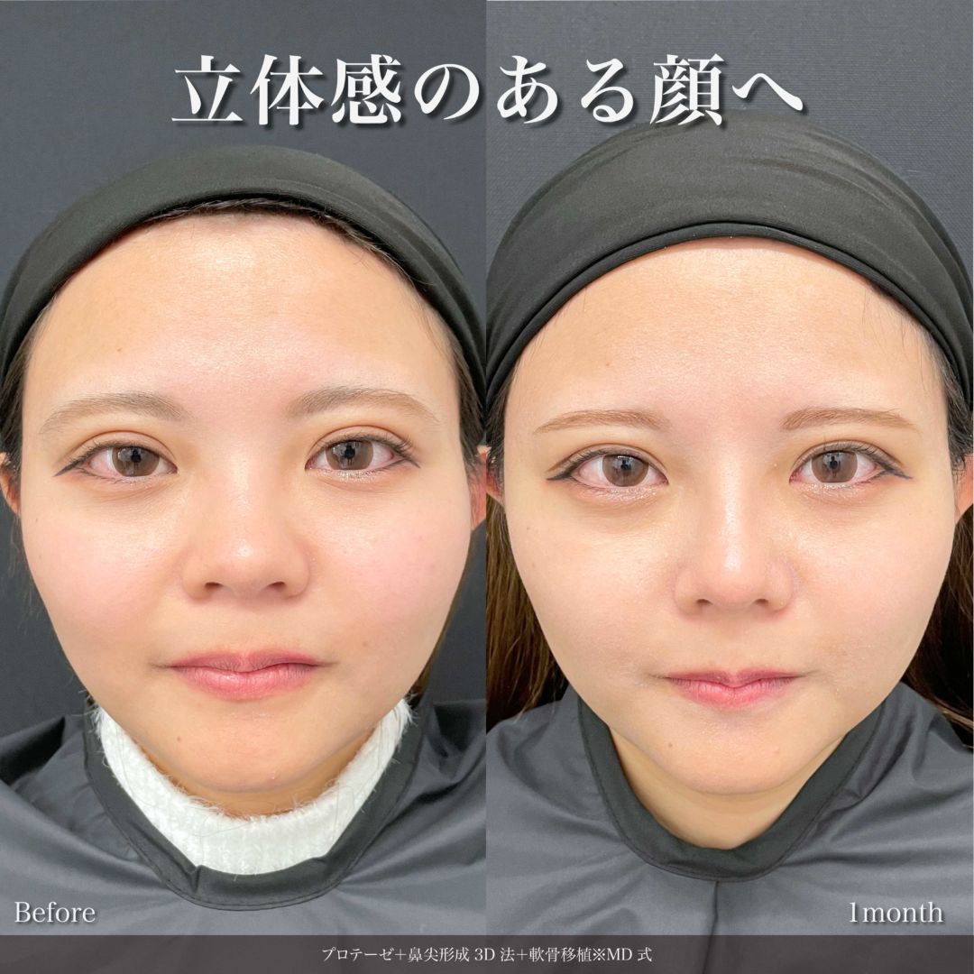 プロテーゼと鼻尖形成3D法と軟骨移植をMD式で受けた女性の症例写真