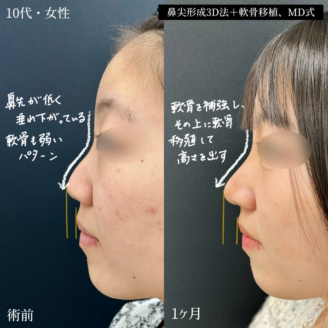 大宮の10代女性の鼻尖形成3D法と軟骨移植の症例