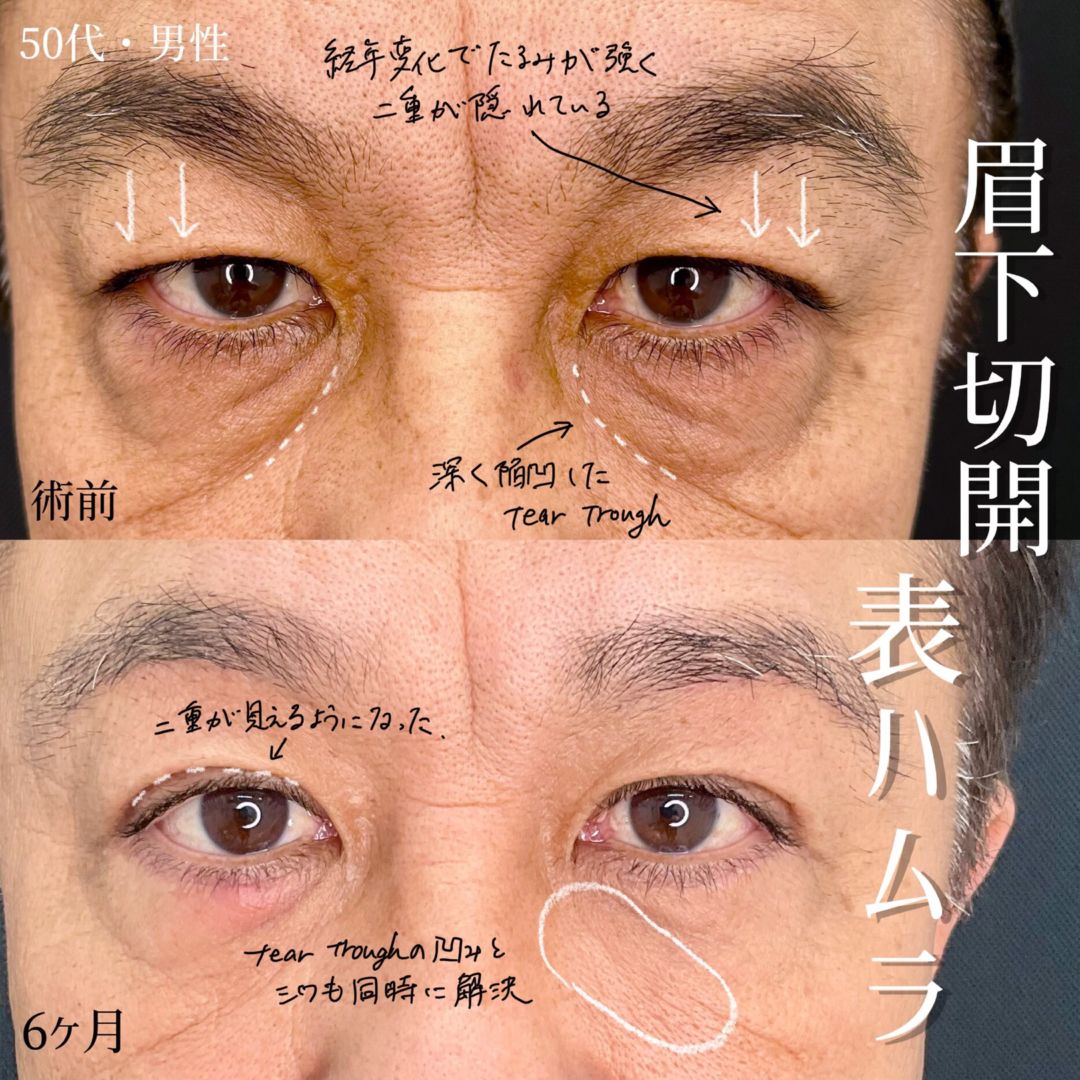 大宮の50代男性の眉下切開の症例