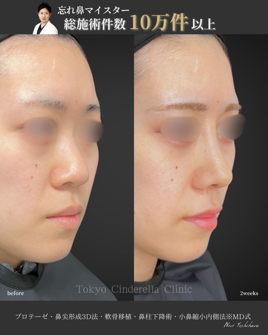 プロテーゼと鼻尖形成3D法と軟骨移植と鼻柱下降術と小鼻縮小内側法をMD式で受けた女性の症例写真