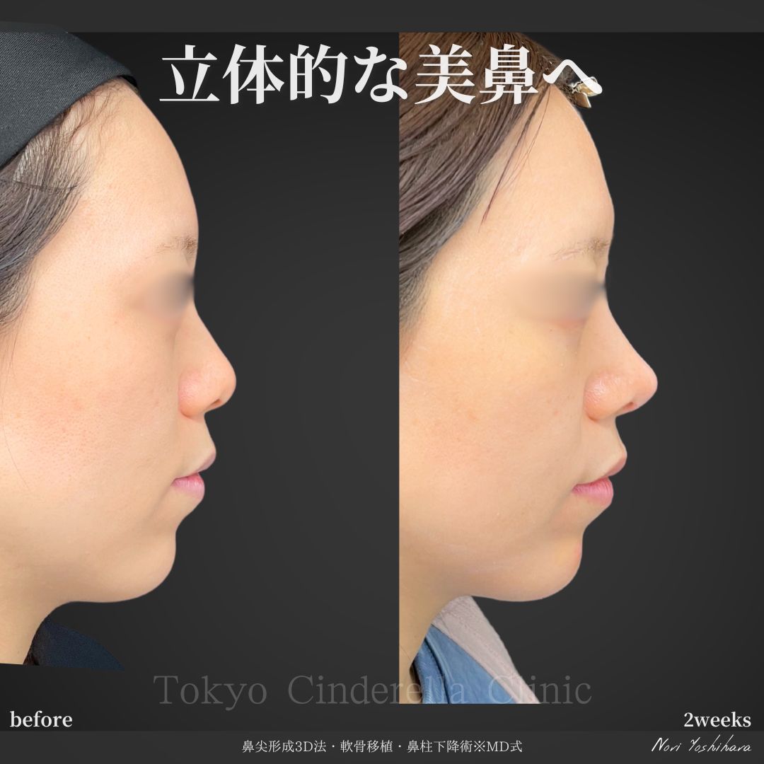 鼻尖形成3D法と軟骨移植と鼻柱下降術をMD式で受けた女性の症例写真