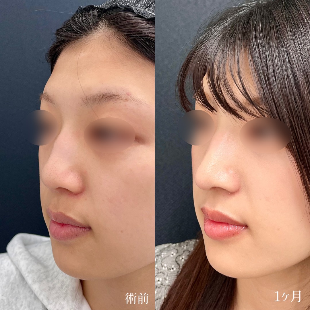 大宮の20代女性の鼻尖形成の症例