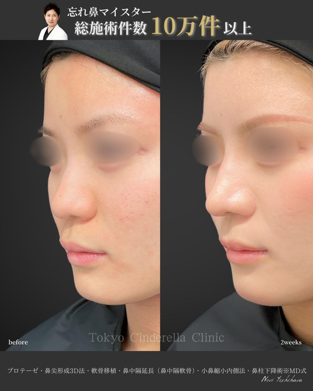 プロテーゼと鼻尖形成3D法と軟骨移植と小鼻縮小内側法と鼻柱下降を受けた女性の症例写真