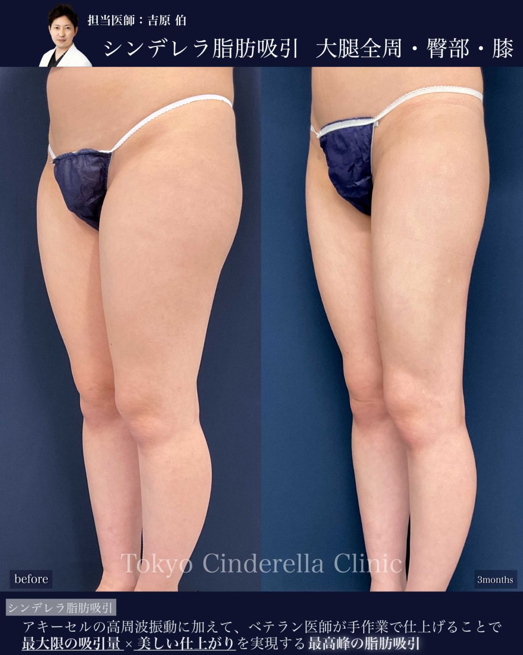 太ももとお尻と膝のシンデレラ脂肪吸引を受けた女性の症例写真