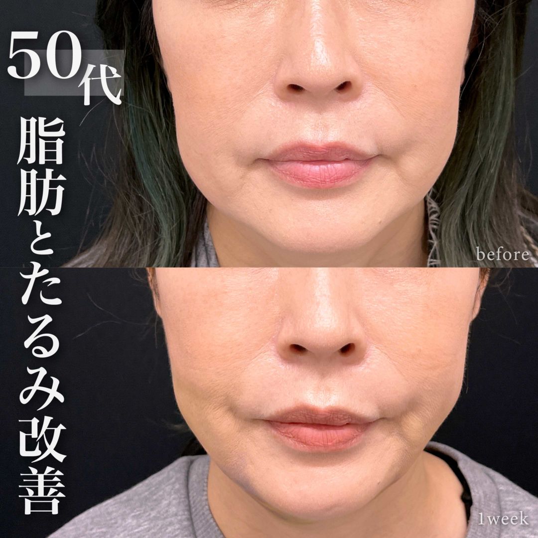 頬の脂肪吸引と糸リフト併用でたるみ改善した50代女性の1週間の症例