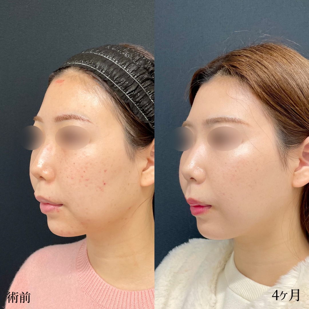 大宮の20代女性のバッカルファット除去の小顔整形の症例