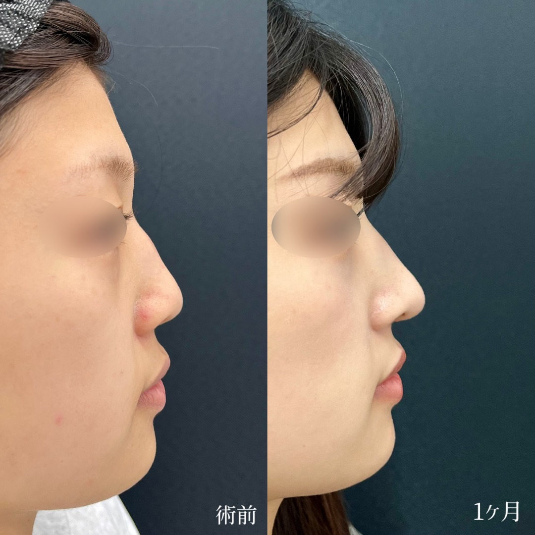 大宮の20代女性のわし鼻修正の症例