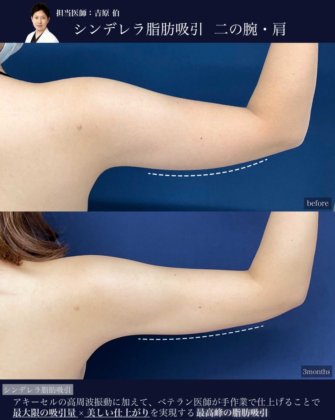 二の腕肩のシンデレラ脂肪吸引の症例
