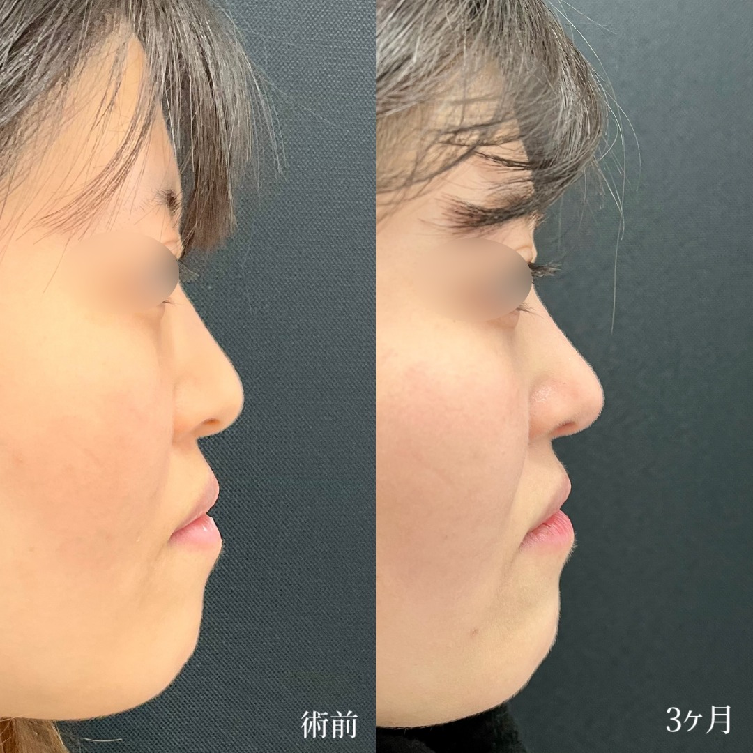 大宮の20代女性の鼻尖形成3D法の症例