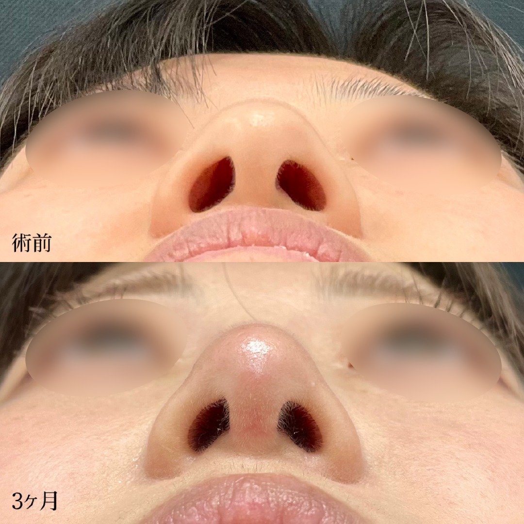 大宮の20代女性の小鼻縮小内側法の症例