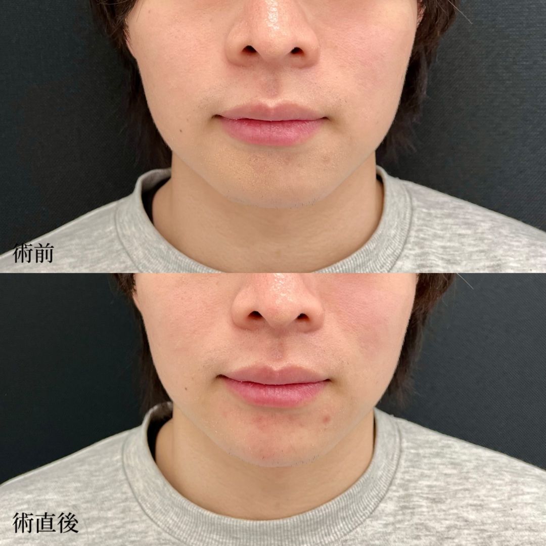 大宮の20代男性の顎ヒアルロン酸の症例