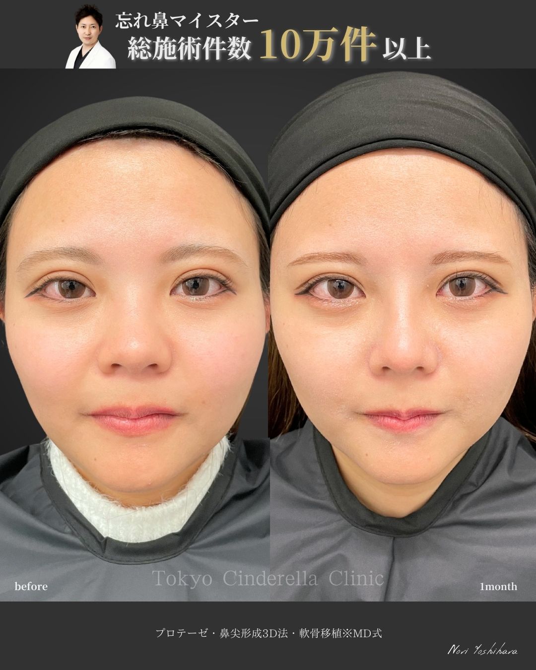 プロテーゼと鼻尖形成3D法と軟骨移植をMD式で受けた女性の症例