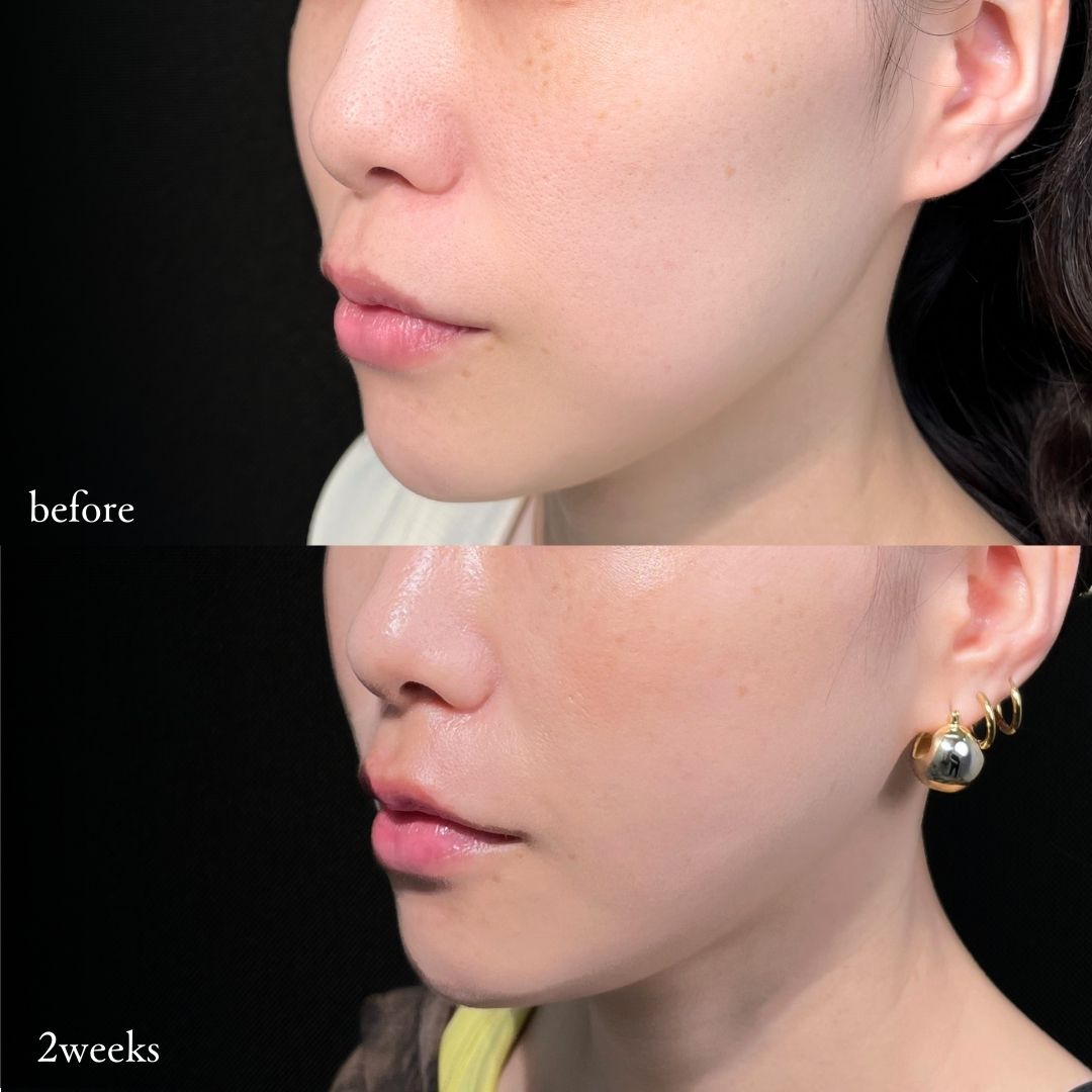 糸リフトで口横のたるみ改善した30代女性、2週間目の症例