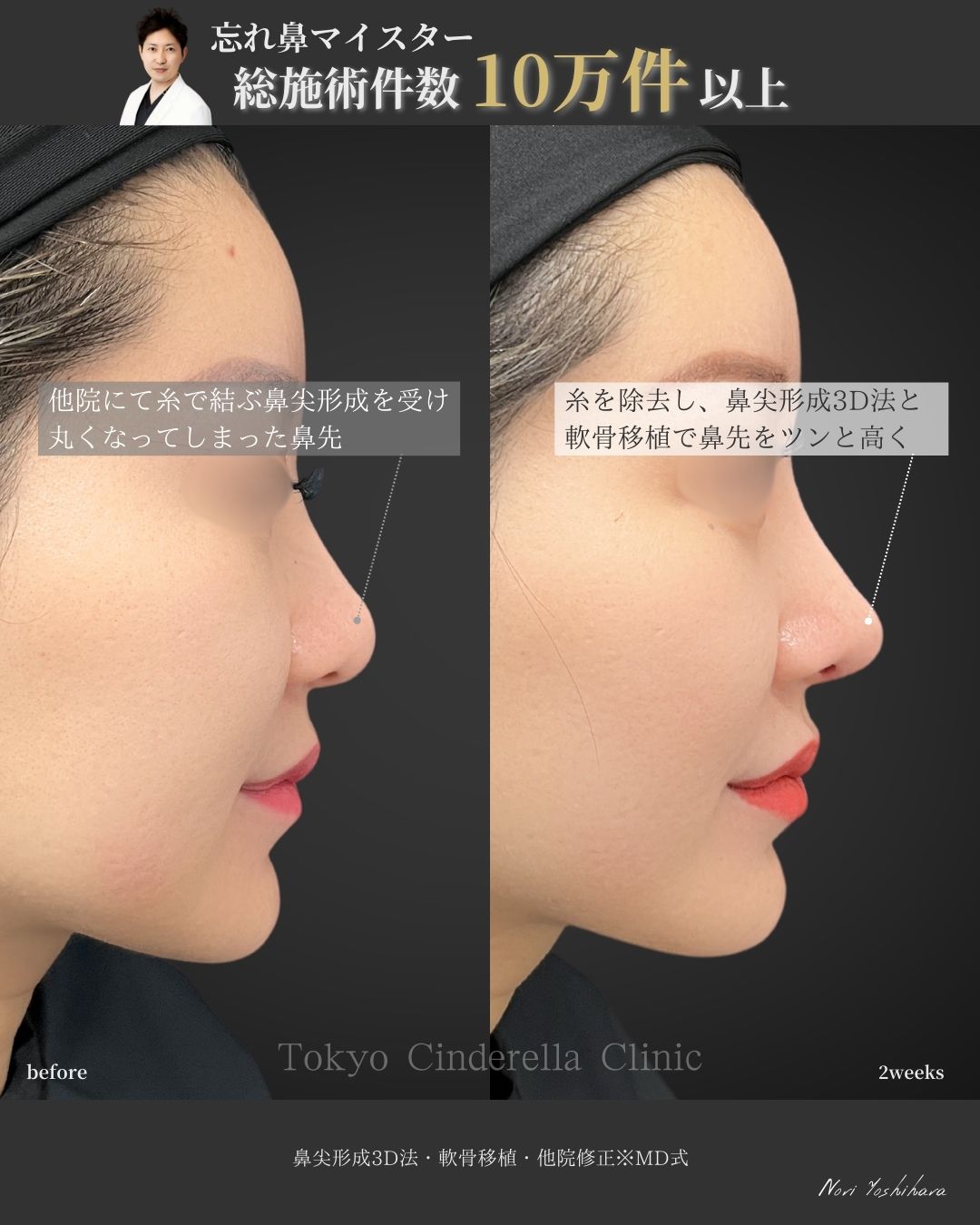 鼻尖形成3D法と軟骨移植をMD式で受けた女性の症例写真