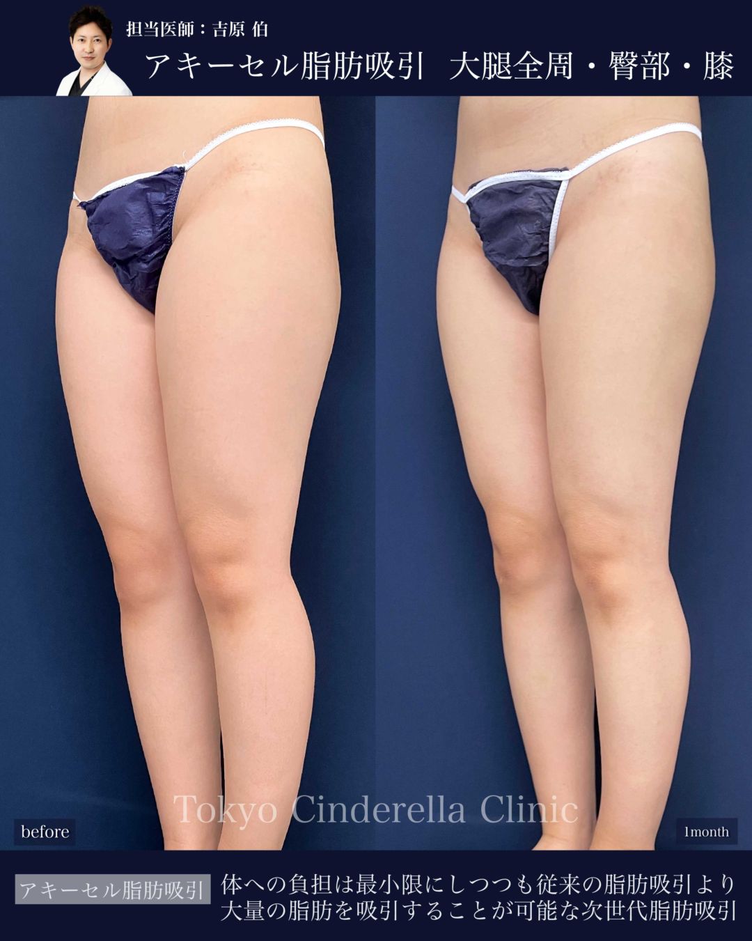 太もも全周と臀部と膝のアキーセル脂肪吸引を受けた女性の症例写真
