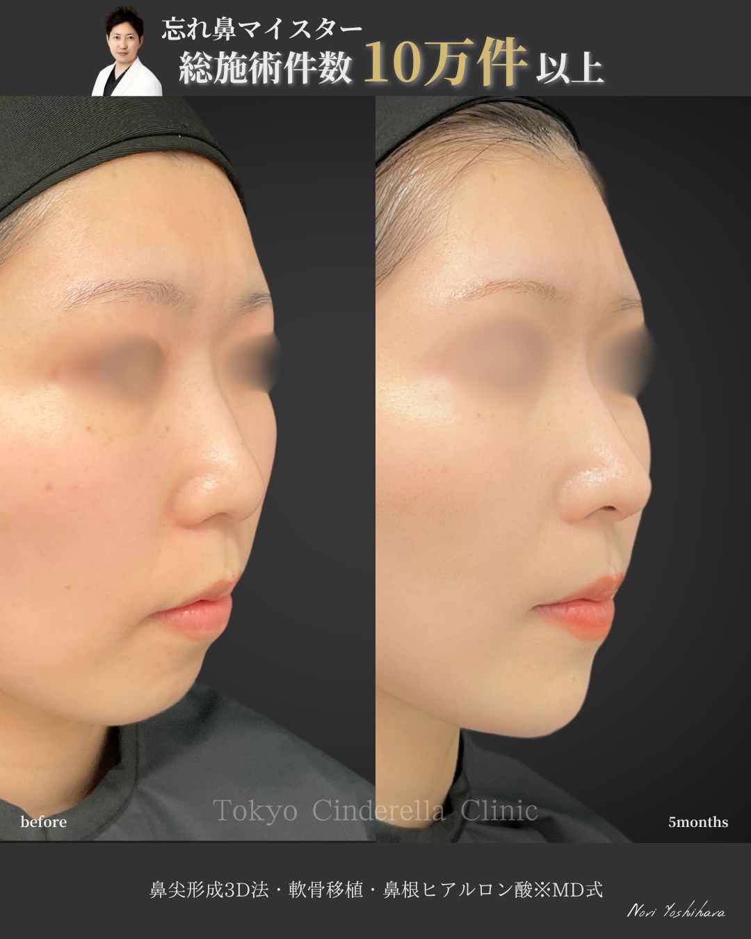 鼻尖形成3D法と軟骨移植と鼻根ヒアルロン酸をMD式で受けた女性の症例