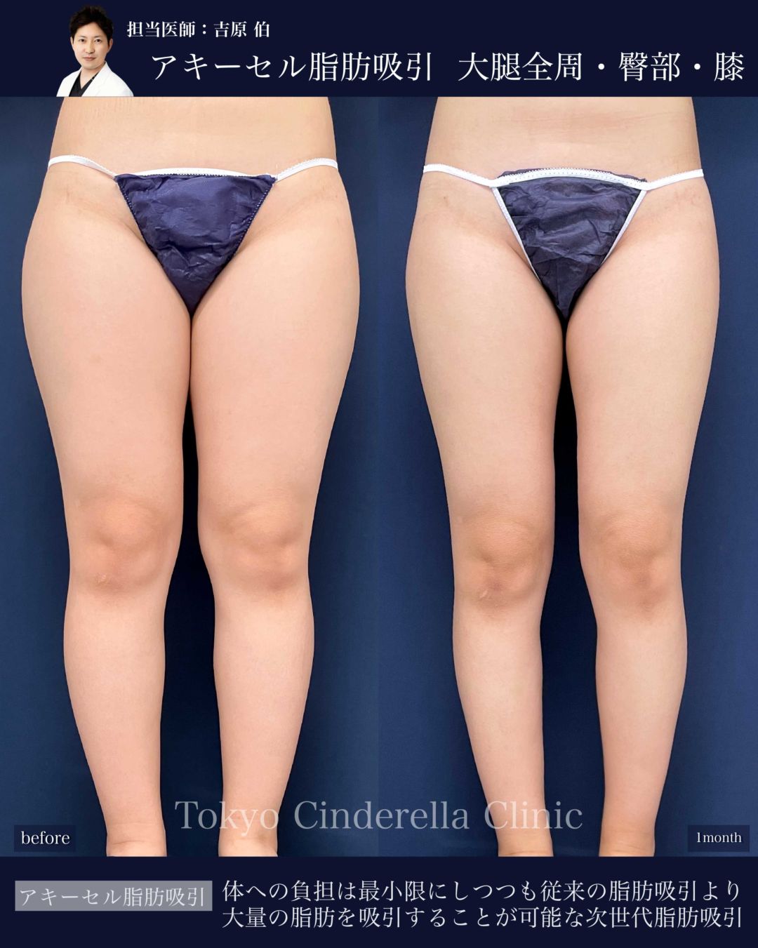 太もも全周と臀部と膝のアキーセル脂肪吸引を受けた女性の症例写真
