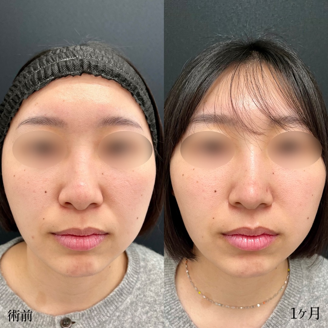 大宮の20代女性の鼻尖形成と軟骨移植の鼻整形の症例