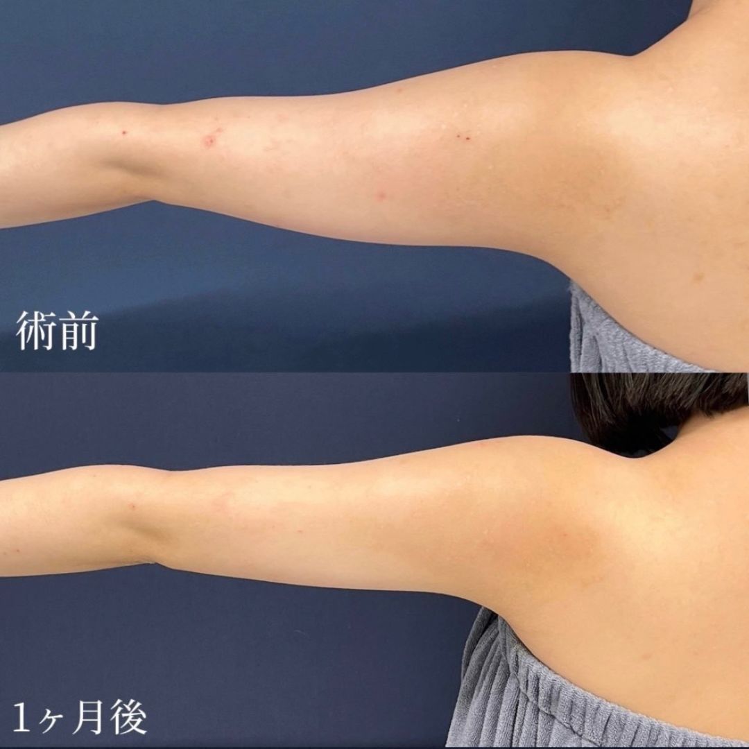 二の腕の脂肪吸引１ヶ月で細い腕になった20代女性の症例