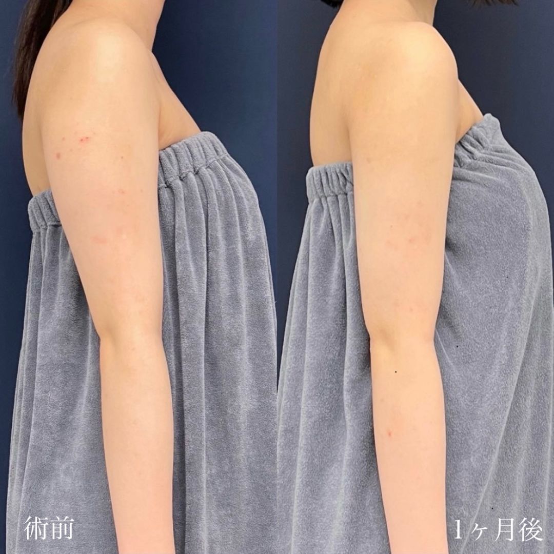 二の腕の脂肪吸引１ヶ月で細い腕になった20代女性の症例