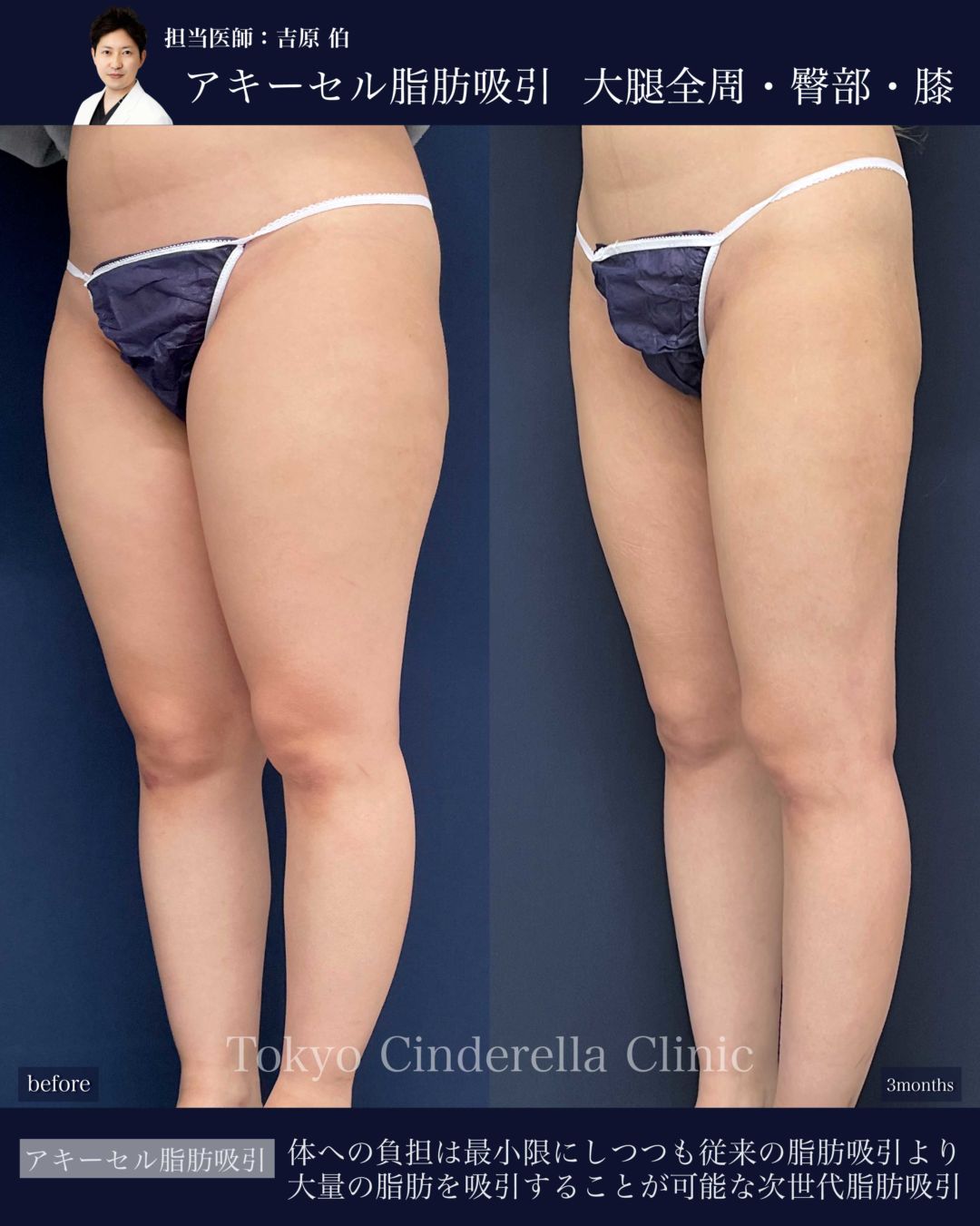 太ももとお尻と膝のアキーセル脂肪吸引をした女性の症例写真