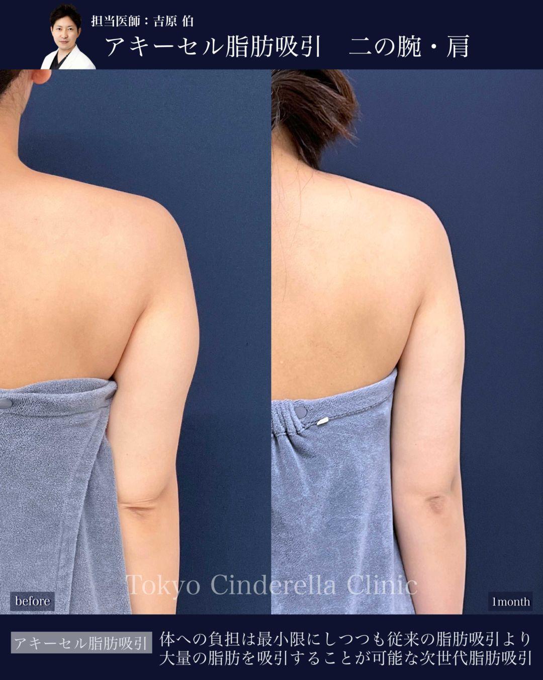 二の腕と肩のアキーセル脂肪吸引を受けた女性の症例写真