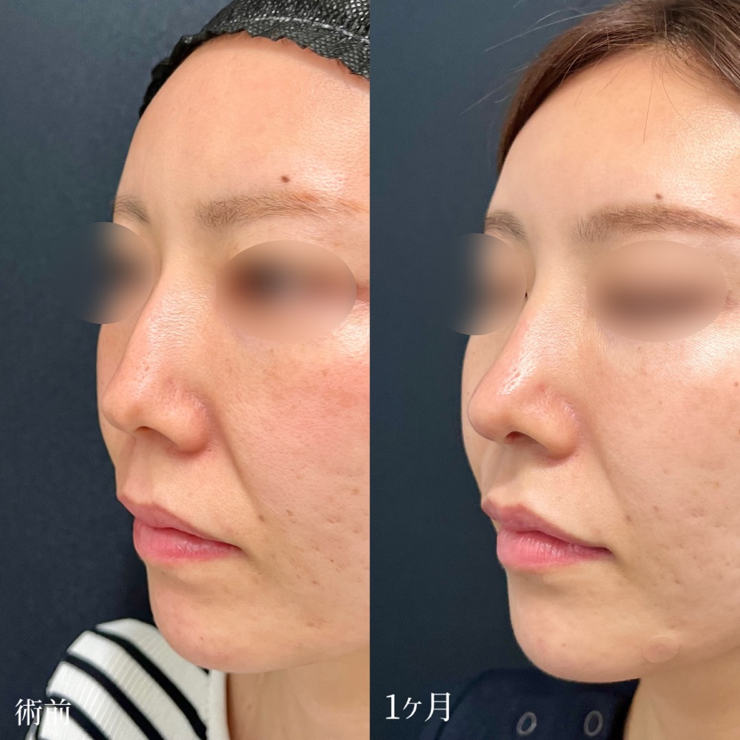 大宮の30代女性の鼻尖形成3D法の症例