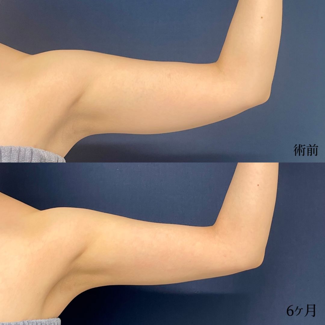 大宮の20代女性の二の腕の脂肪吸引の症例