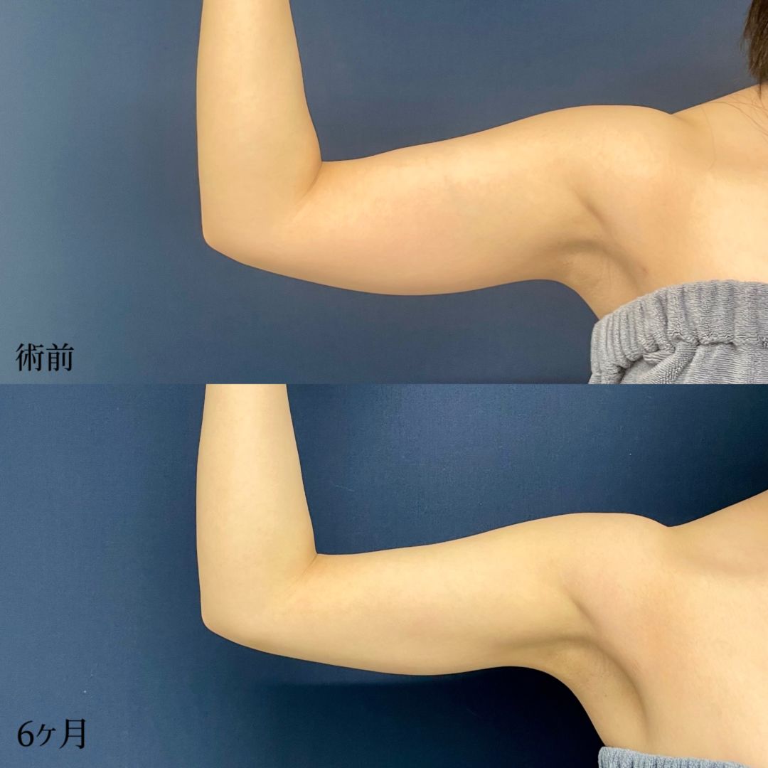 大宮の20代女性の二の腕と肩の脂肪吸引の症例