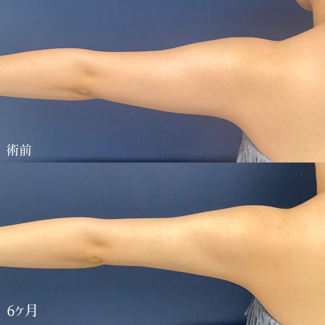 大宮の20代女性の二の腕のアキーセル脂肪吸引の症例