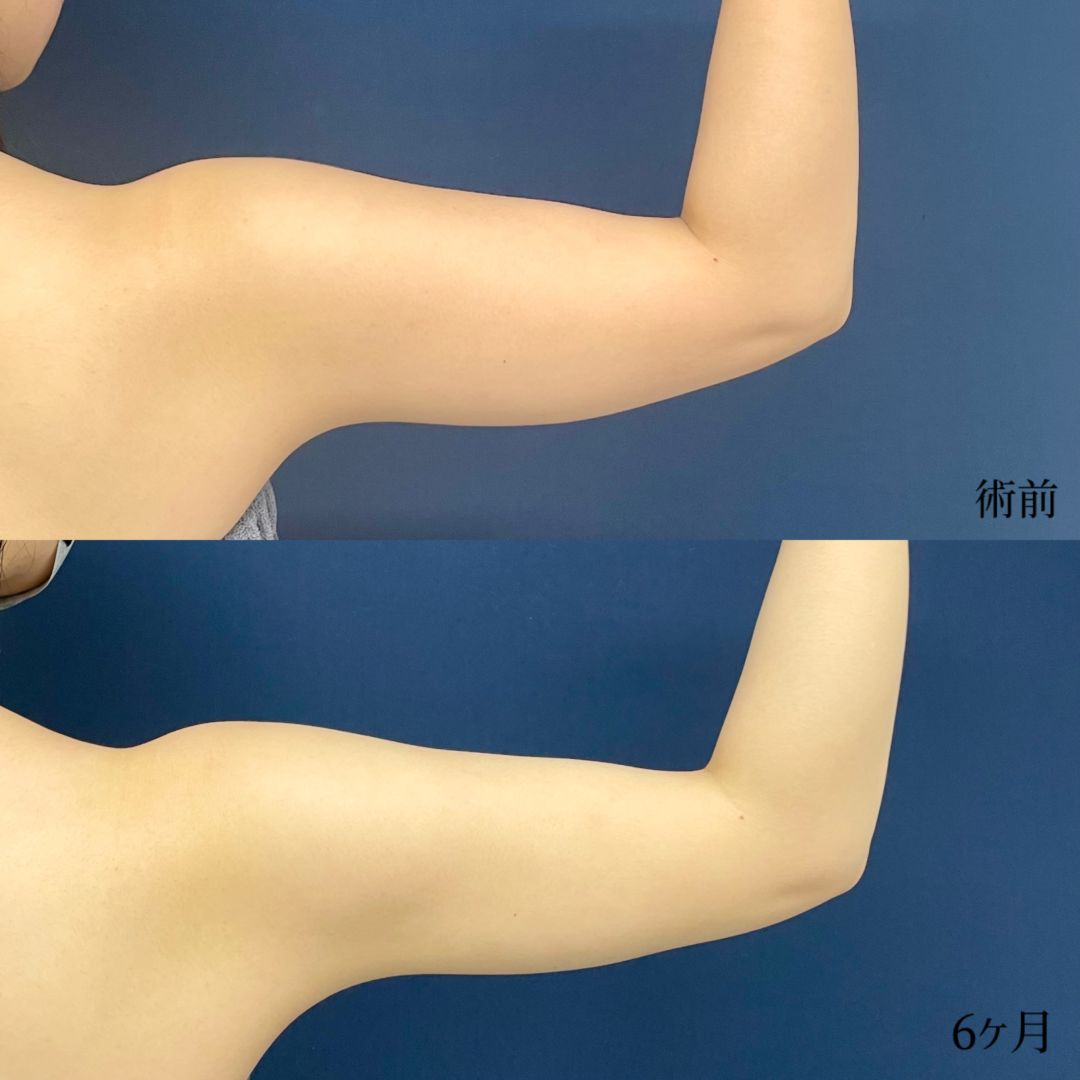 大宮の20代女性の二の腕と肩のアキーセル脂肪吸引の症例