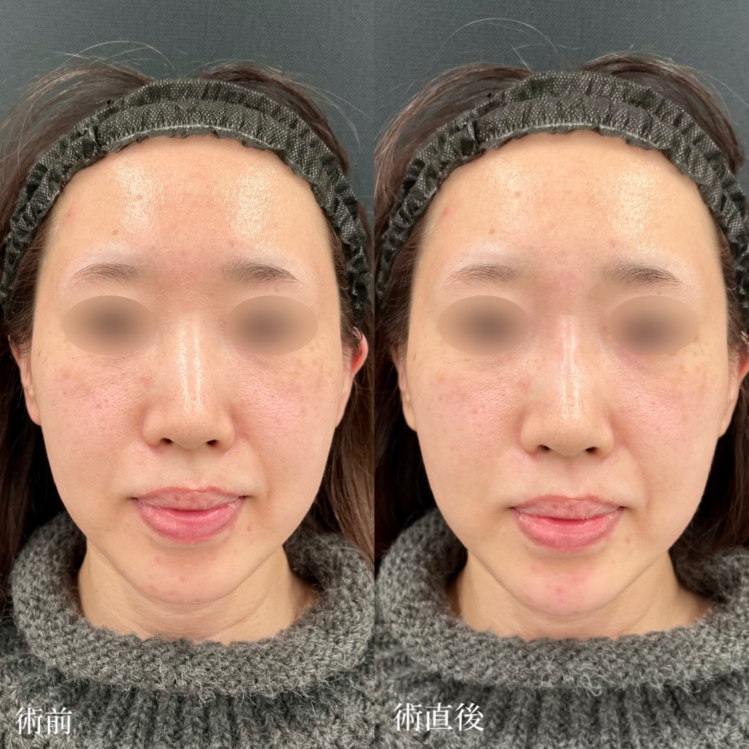 大宮の30代女性の鼻ヒアルロン酸の症例