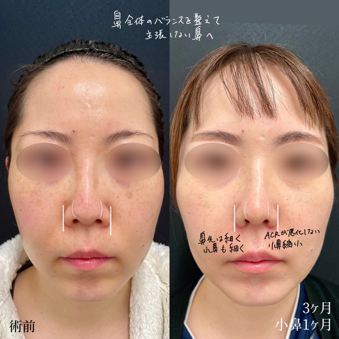 大宮の30代女性の鼻尖形成の症例