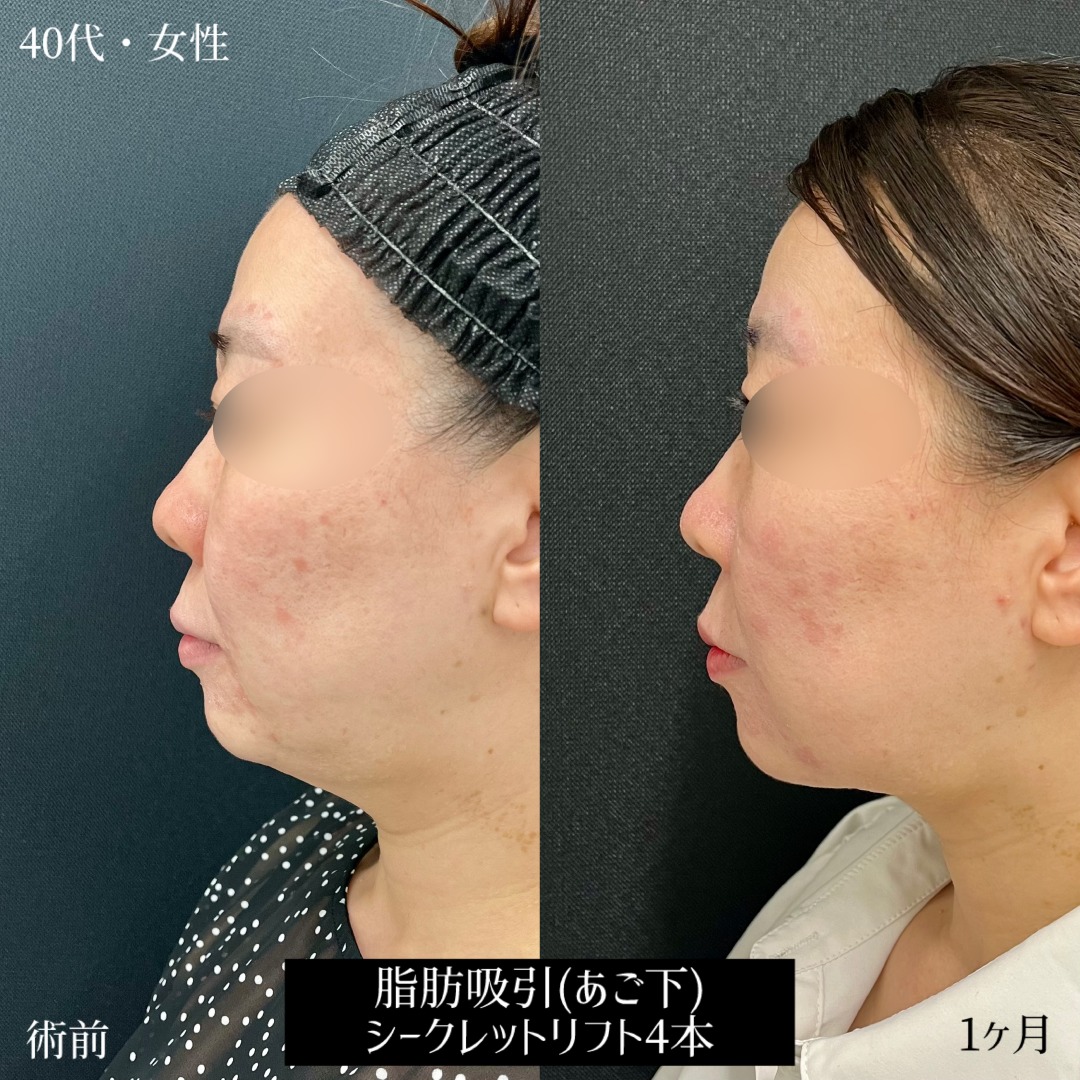 大宮の40代女性の小顔整形の症例