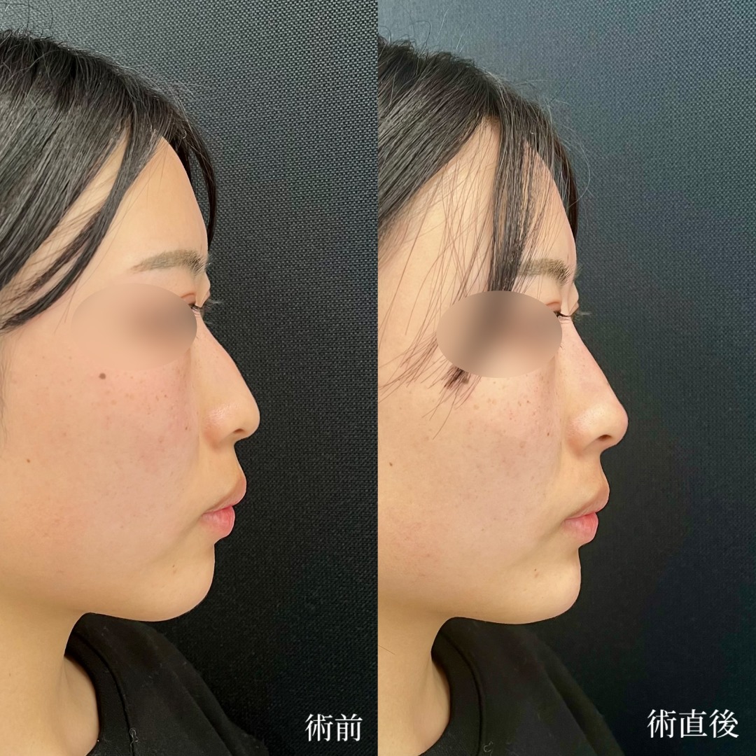 大宮の20代女性の顎のヒアルロン酸の症例