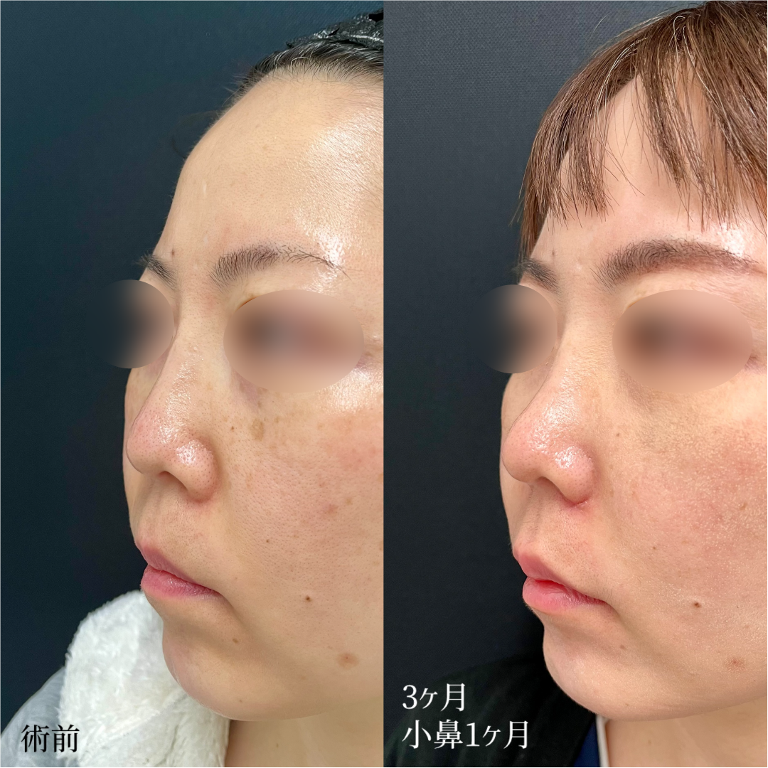 大宮の30代女性の鼻柱下降術の症例