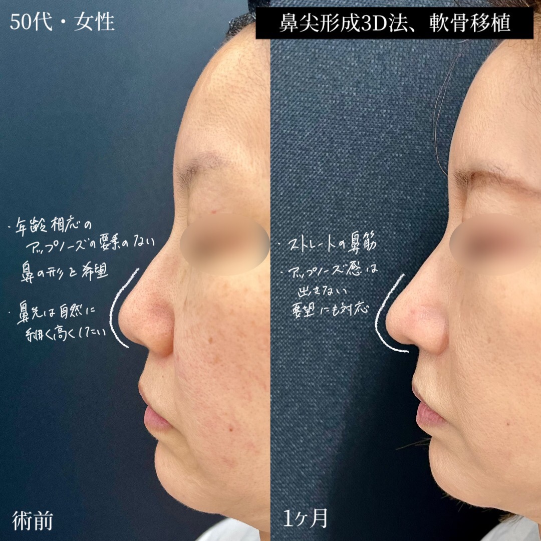 大宮の50代女性の鼻整形の症例