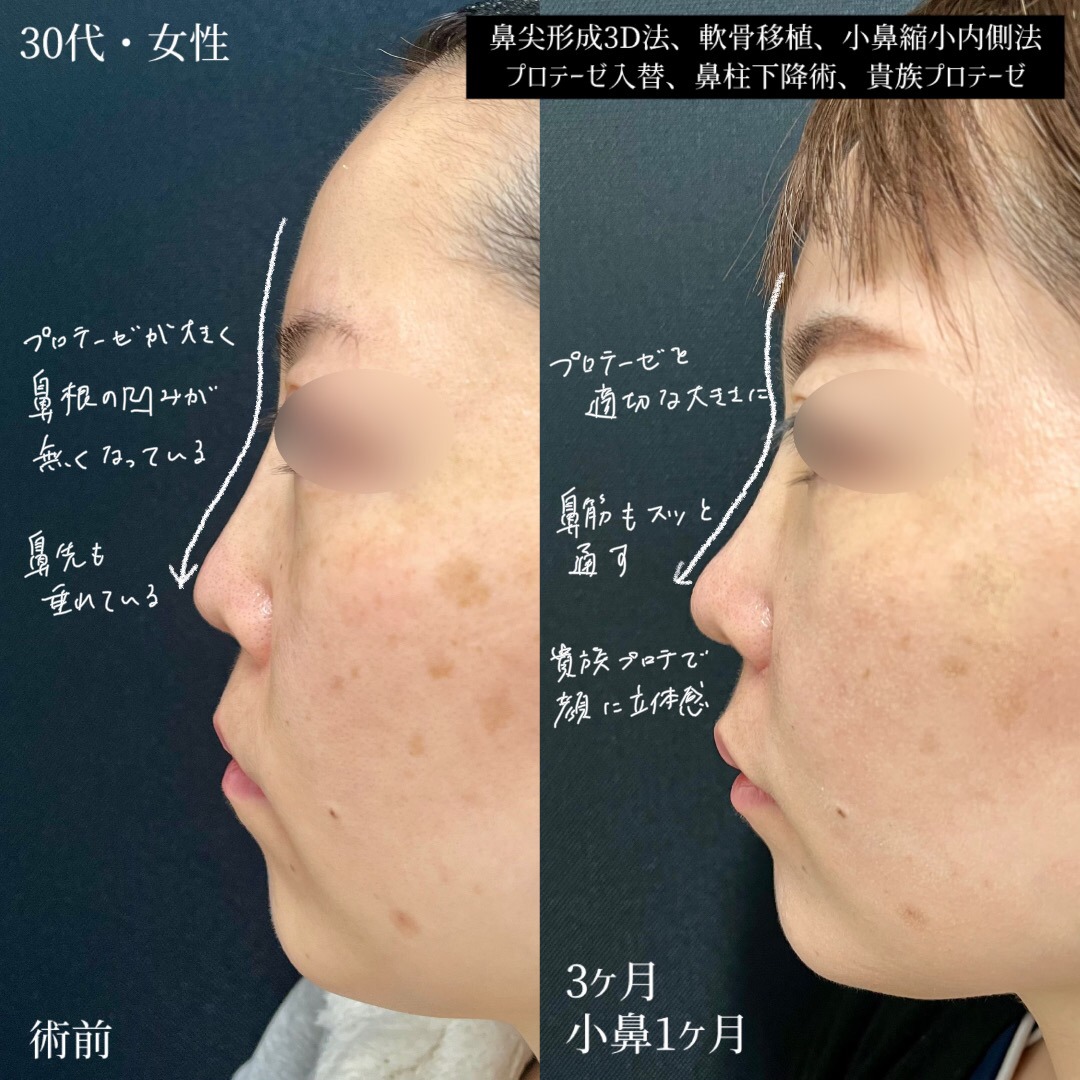 大宮の30代女性の鼻整形の症例