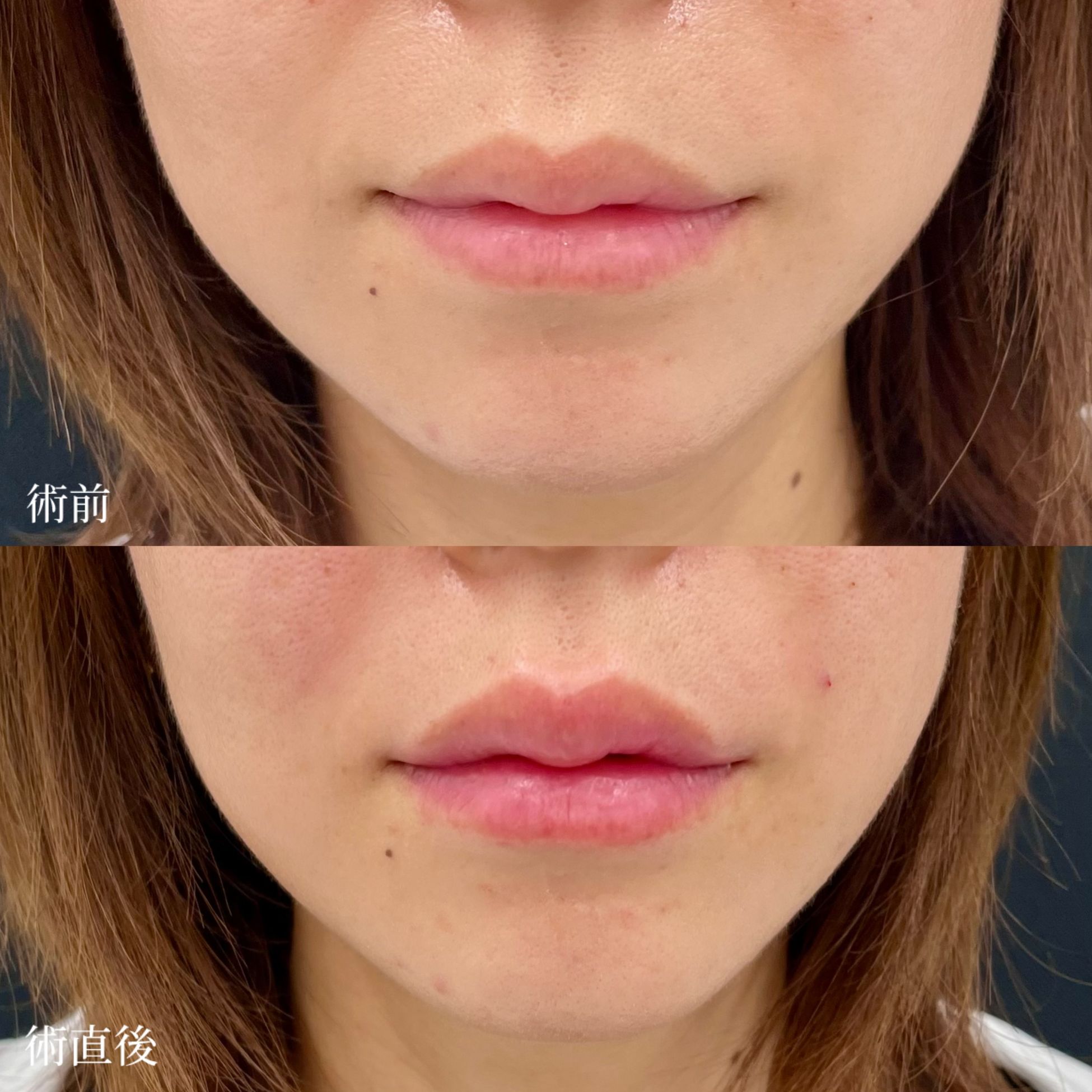 大宮の30代女性の唇ヒアルロン酸の症例