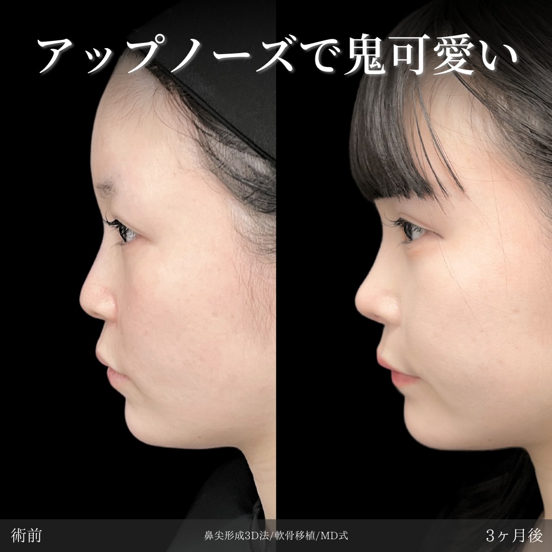 鼻尖形成3D法と軟骨移植をMD式で受けた女性の症例写真