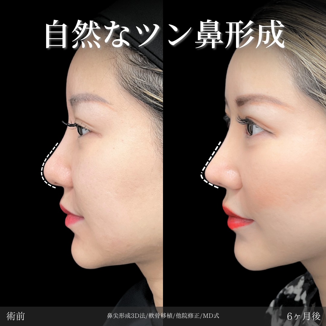 鼻尖形成3D法と軟骨移植と他院修正をMD式で受けた女性の症例写真