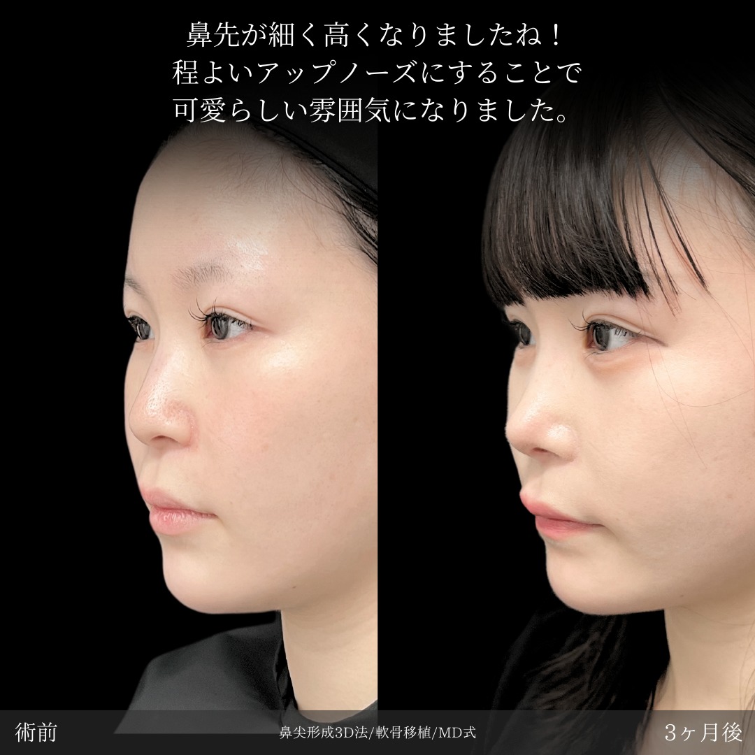 鼻尖形成3D法と軟骨移植をMD式で受けた女性の症例写真