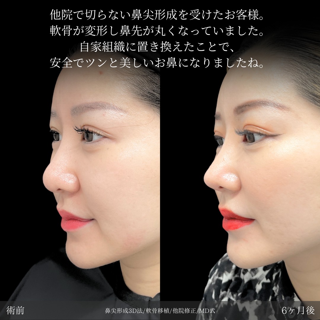 鼻尖形成3D法と軟骨移植と他院修正をMD式で受けた女性の症例写真